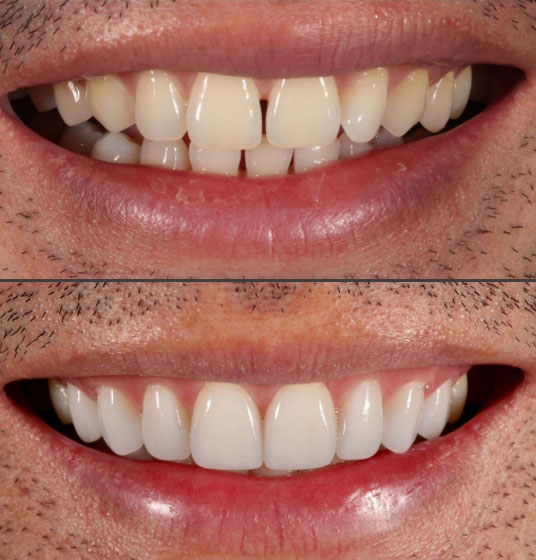 before and after a smile makeover from Gillespie Dentistry in Vancouver, WA